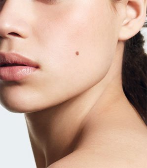 mole removal